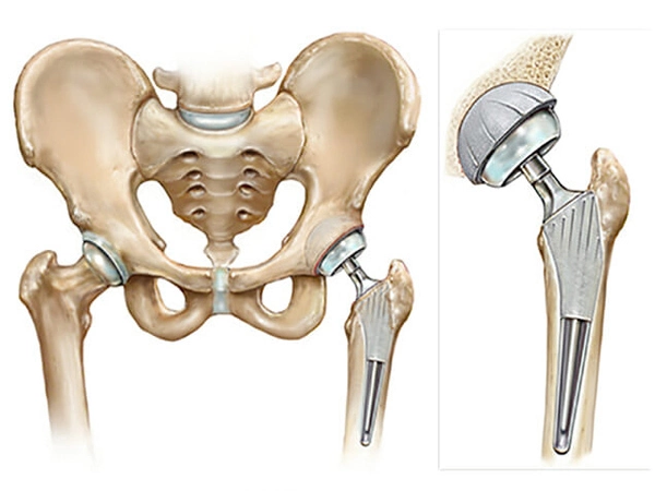Revision Hip Replacement Surgery