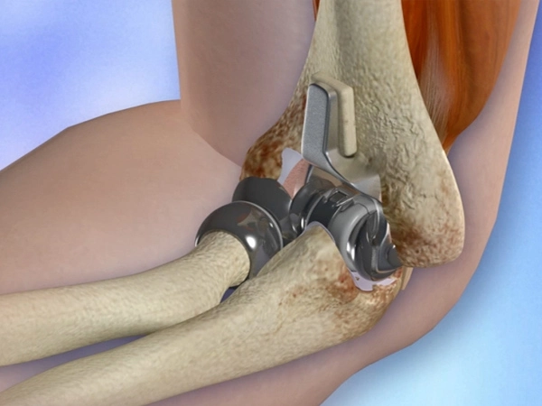 Total elbow Replacement